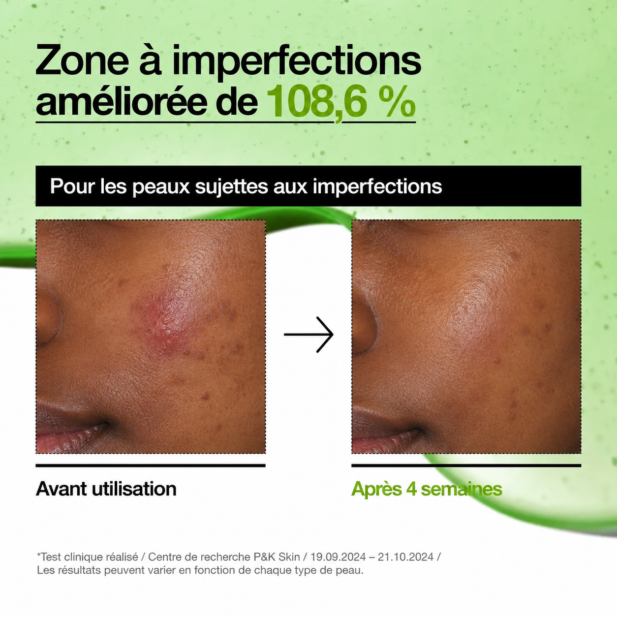 ANUA – Sérum apaisant contre les rougeurs à l'acide azélaïque 10 + acide hyaluronique – Image 7